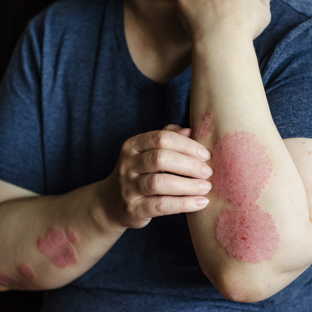 Inovativní terapie pro lidi trpící plakovou psoriázou, Bezplatná konzultace s dermatologem v Centru klinických studií Pratia.